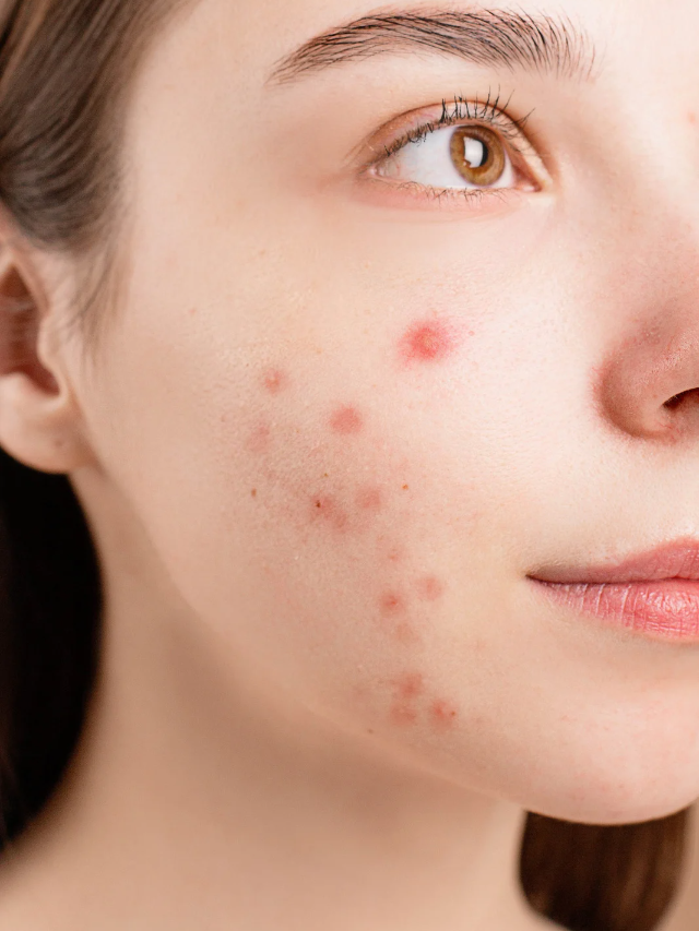 pimples