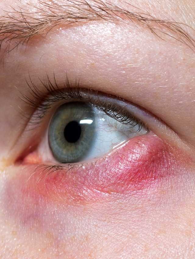 Eye-infection